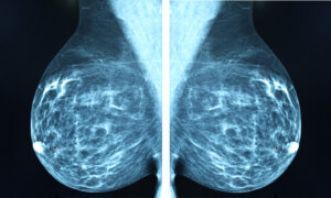 Is AI the Future of Breast Cancer Detection?