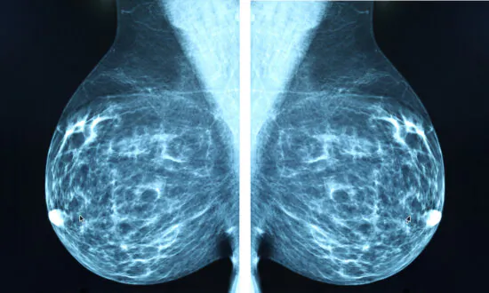 Is AI the Future of Breast Cancer Detection?