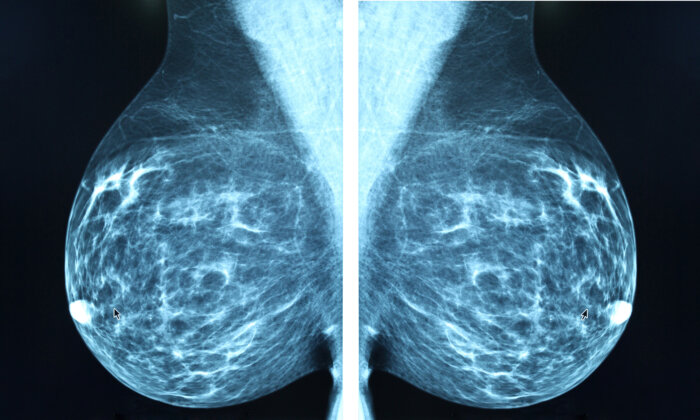 Is AI the Future of Breast Cancer Detection?