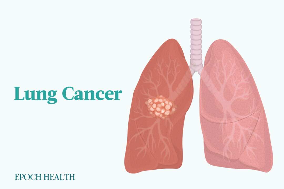 Lung cancer is the leading cause of cancer-related deaths worldwide and the third most common cancer in the United States. (Illustrations from Shutterstock/Designed by The Epoch Times)