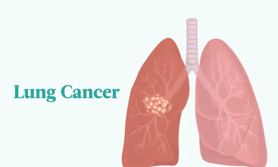 Lung Cancer: Symptoms, Causes, Treatments, and Natural Approaches