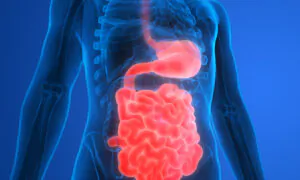 Managing Diverticulitis: A Comprehensive Approach