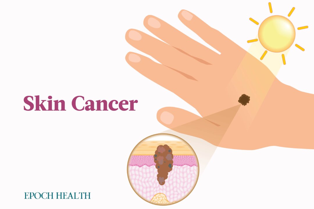 Skin cancer may be the most common cancer in the United States, but luckily, it is highly treatable when caught early. (Illustrations from Shutterstock/Designed by The Epoch Times)