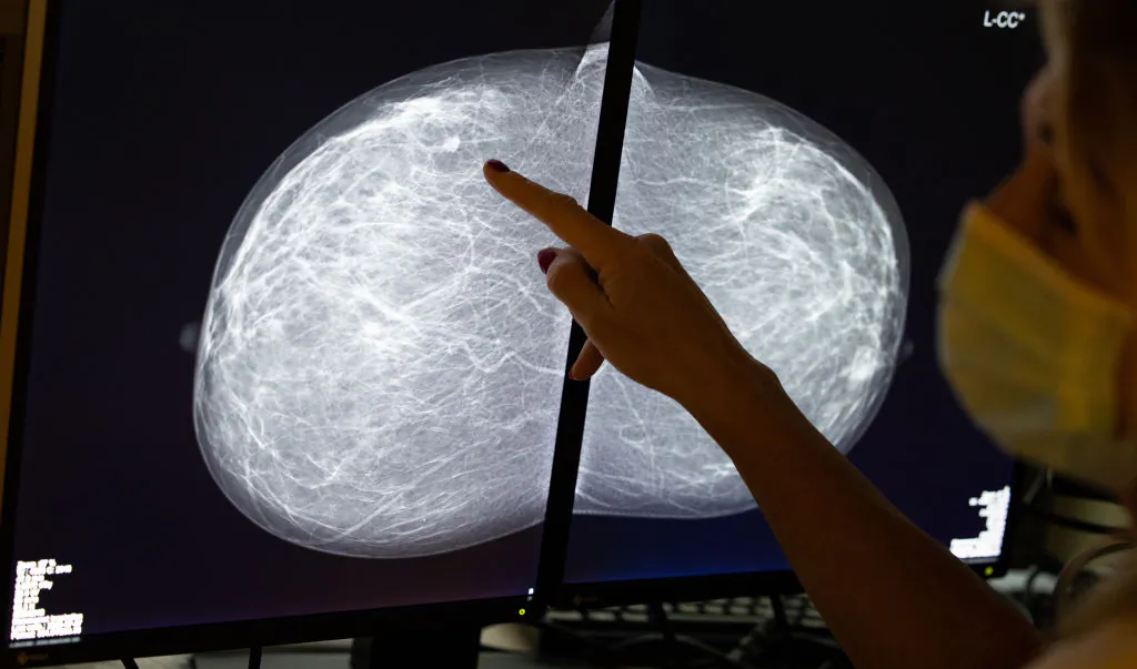 Illustration shows a mammography at the breast clinic of Saint-Jean Clinique in Brussels, Oct. 16 2020. (Benoit Doppagne/BELGA MAG/AFP via Getty Images)