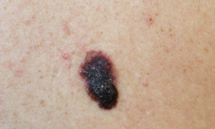 FDA Approves 1st T-Cell Therapy for Melanoma