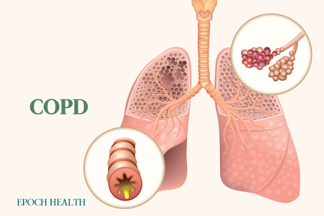 Chronic obstructive pulmonary disorder (COPD) often goes undetected in its early stages. (Illustration by The Epoch Times, Shutterstock)