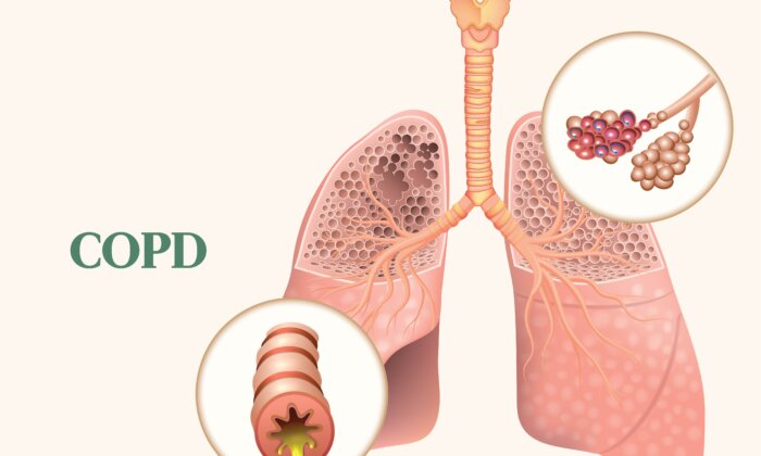 COPD: Incurable Lung Disease With 4 Main Symptoms