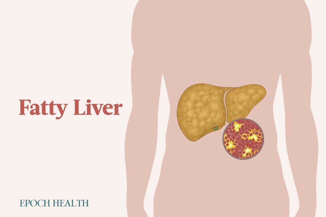 Nonalcoholic fatty liver disease is the most common liver disease in the world. (Illustrations by The Epoch Times, Shutterstock)
