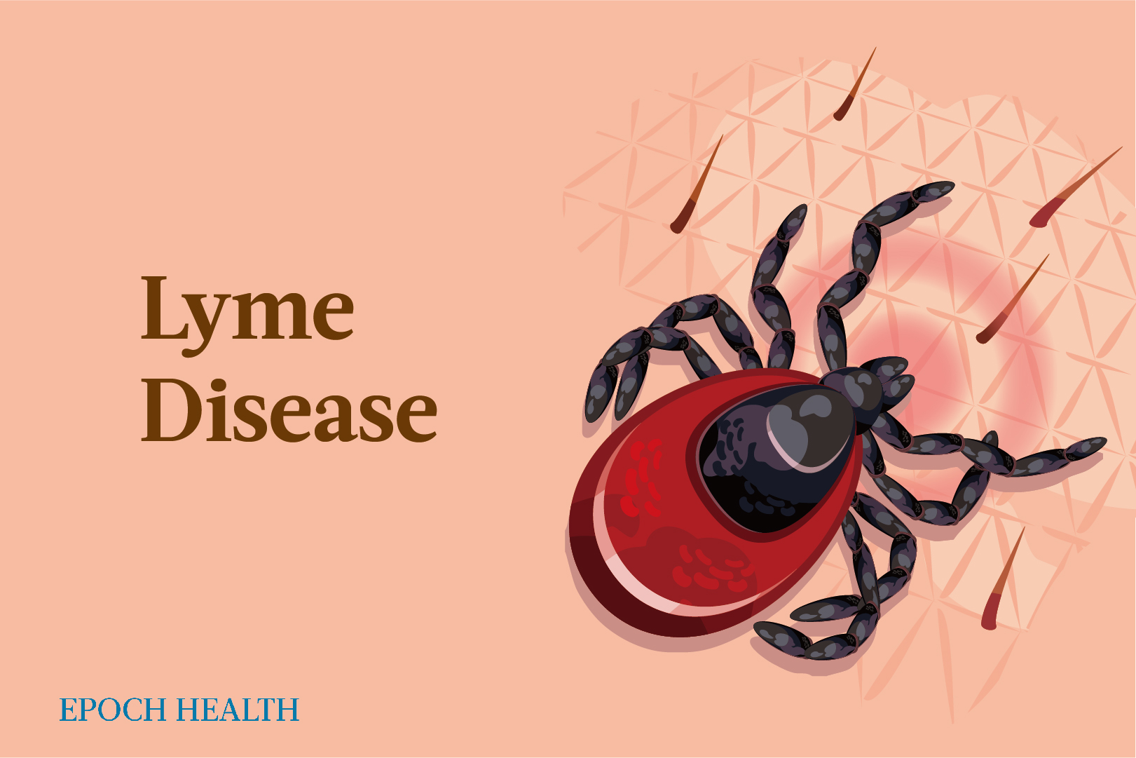 Lyme Disease: Symptoms, Causes, Treatments, and Natural Approaches