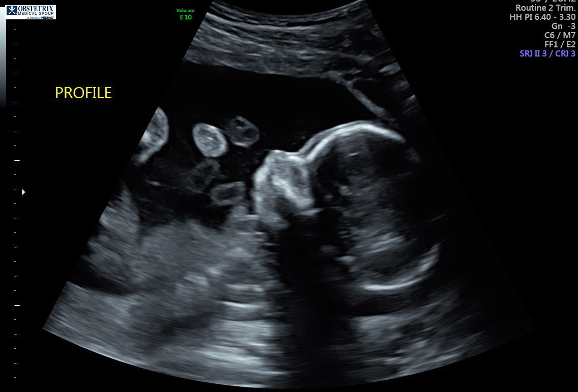 Ultrasound image of Ms. Howard‘s fetus.