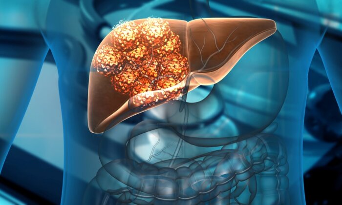 Liver Cancer: Diagnosis and Treatment for a 'Silent' Threat