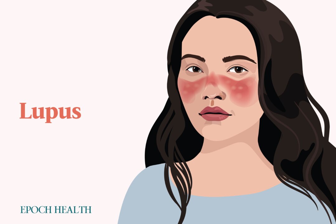 Lupus is often associated with a distinctive facial butterfly rash, but only about 30 percent of patients develop it. (Illustrations by Shutterstock, The Epoch Times)