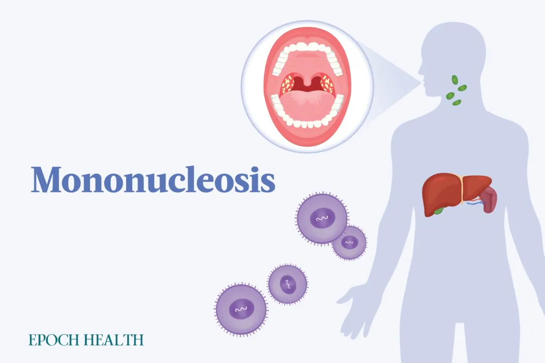 Mononucleosis is most common among teenagers and young adults. (Illustrations by The Epoch Times, Shutterstock)