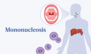 The Essential Guide to Mononucleosis: Symptoms, Causes, Treatments, and Natural Approaches