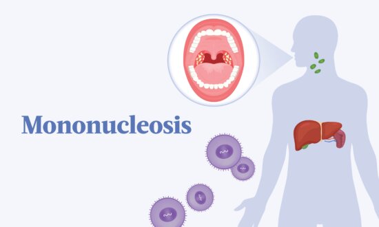 The Essential Guide to Mononucleosis: Symptoms, Causes, Treatments, and Natural Approaches