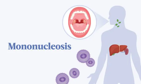 Mononucleosis: Symptoms, Causes, Treatments, and Natural Approaches