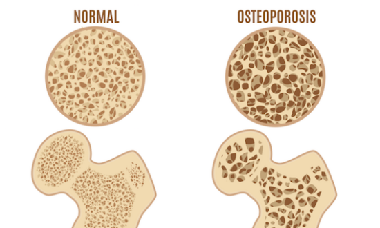 Guarding Against Osteoporosis: Unveiling Risk Factors and Time-Honored Prevention Methods