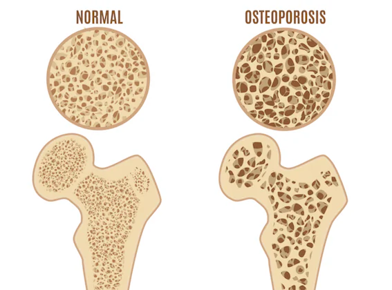 Guarding Against Osteoporosis: Unveiling Risk Factors and Time-Honored Prevention Methods