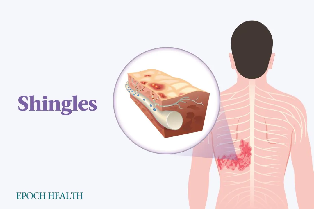 The risk of shingles and its complications increases with age. (Illustrations by The Epoch Times, Shutterstock)