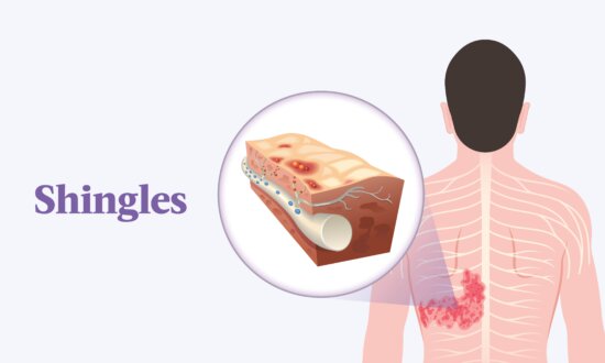 Major Cause of Shingles