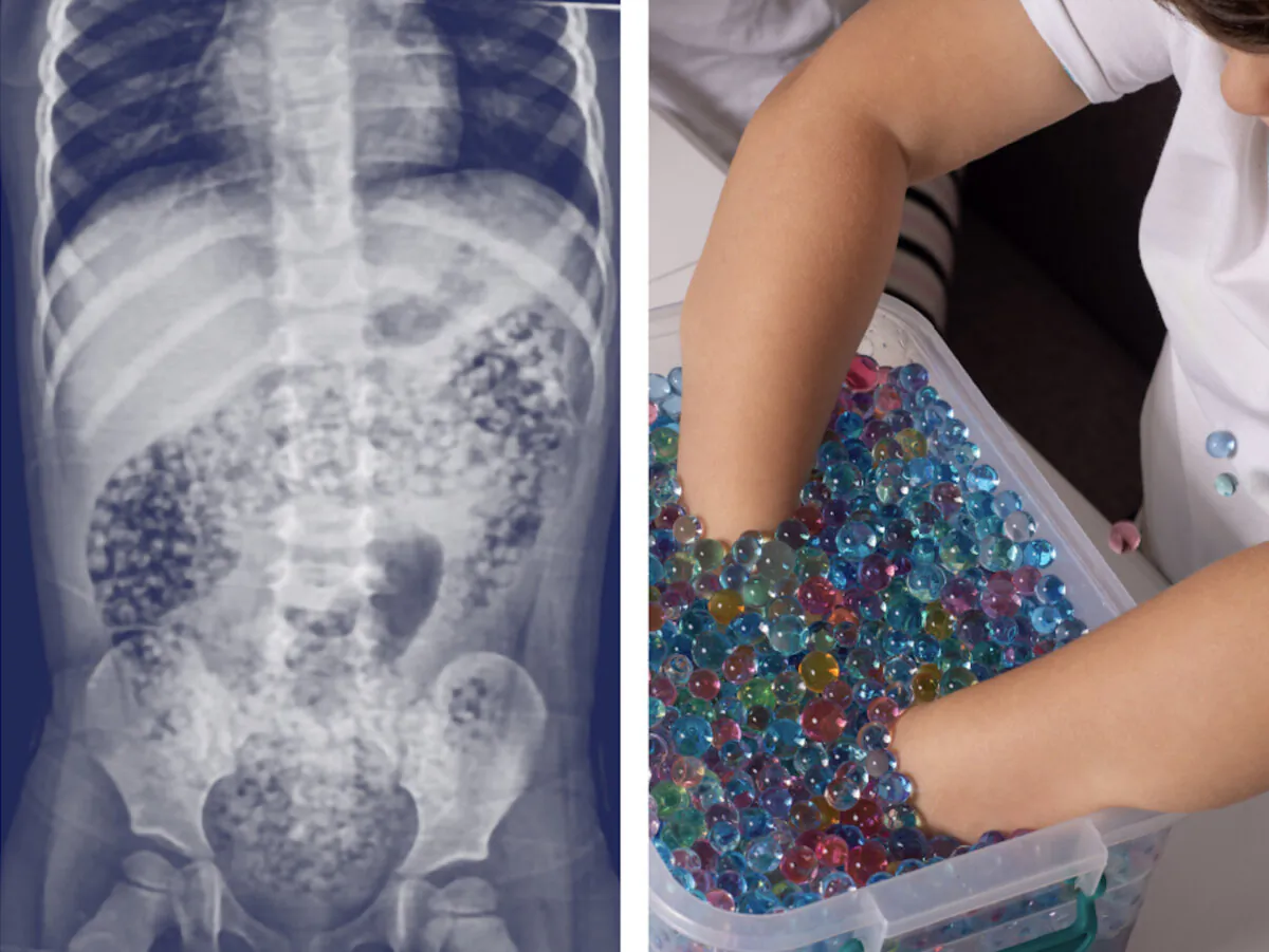 (L) Undated x-ray showing expanded water beads inside the body of a child; (R) Undated photo of a child playing with a tub of water beads. (CPSC)