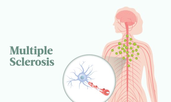 Major Cause of Multiple Sclerosis