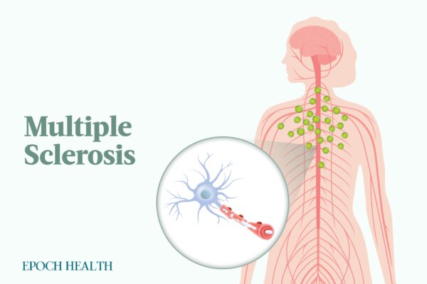 Multiple Sclerosis: Symptoms, Causes, Treatments, and Natural Approaches