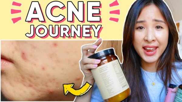 How I Used Food, Supplements, and Nutrition to Clear My Acne, Naturally