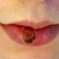chancre ulcer syphilis