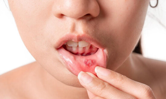 Help Heal Mouth Sores Faster With These 6 Tips