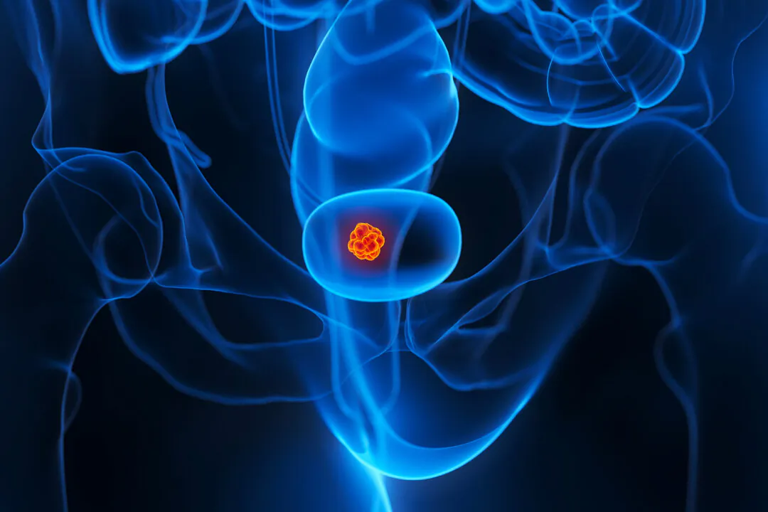 New First-Line Treatment for Bladder Cancer Approved by FDA