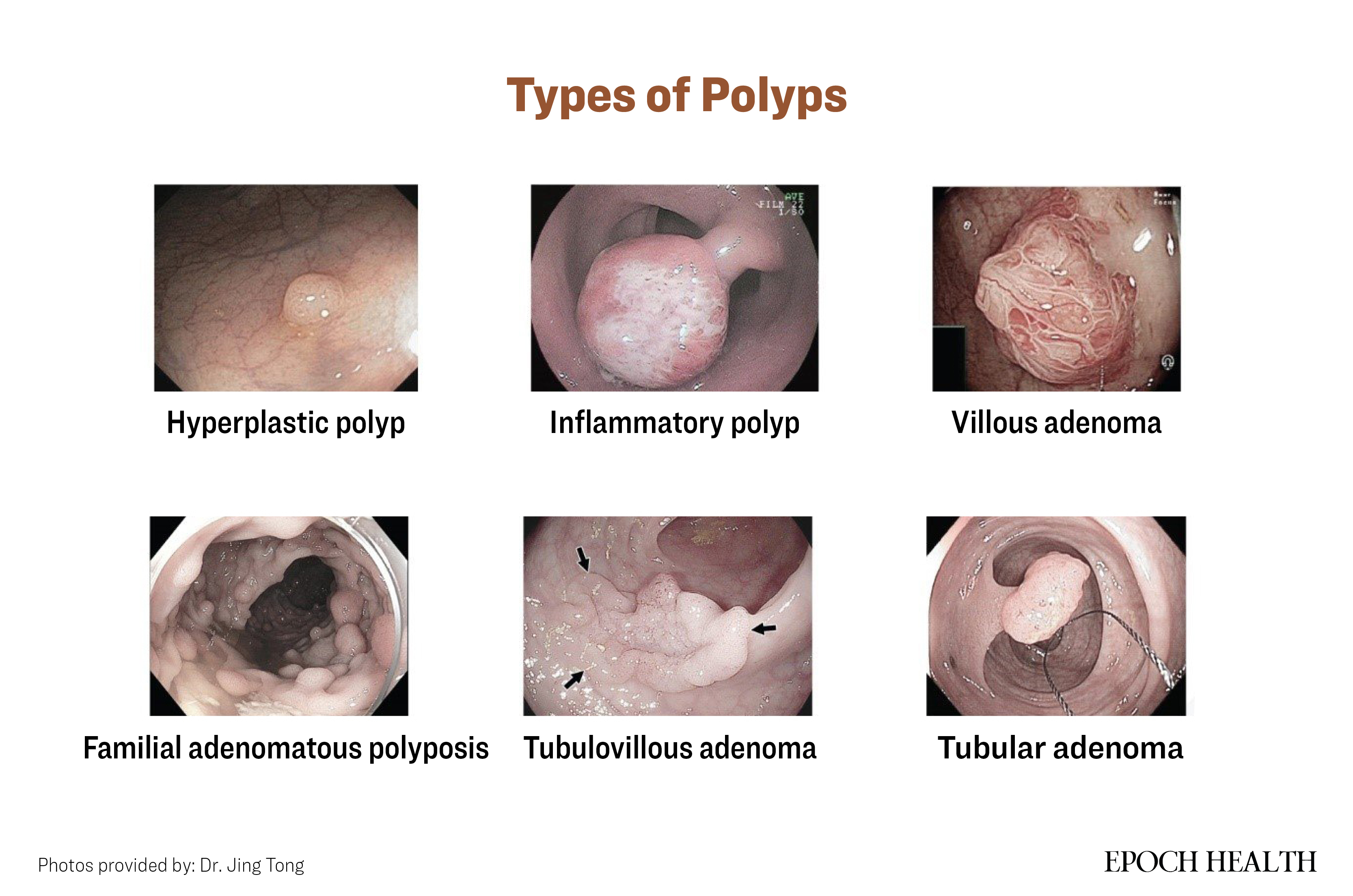 Polyps are generally categorized into five major types. (The Epoch Times)