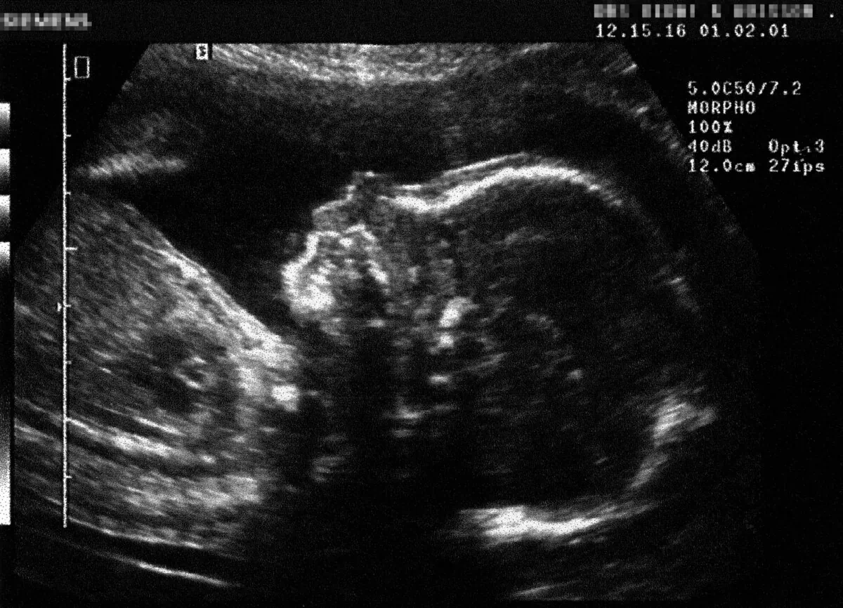 An ultrasound of a fetus, approximately five months after conception, taken in February 2001. (Didier Pallages/AFP via Getty Images)