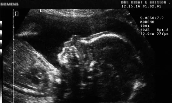 ACU Offers Refund, Counselling for Those Who Walked Out During Anti-Abortion Remarks