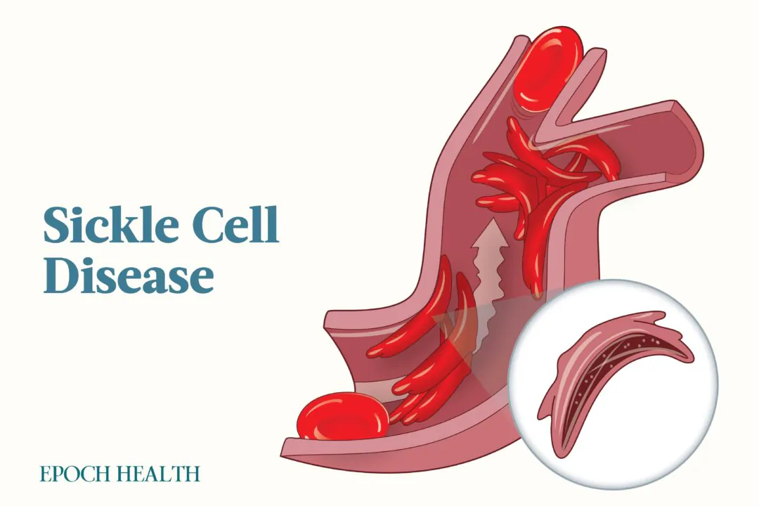 Sickle cell disease is a genetic blood disorder most common among those of African descent. (Illustrations by The Epoch Times, Shutterstock)