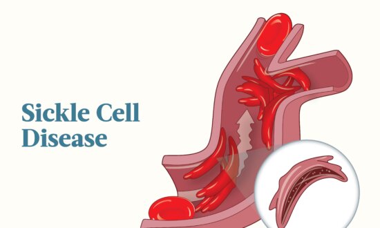 The Essential Guide to Sickle Cell Disease: Symptoms, Causes, Treatments, and Natural Approaches