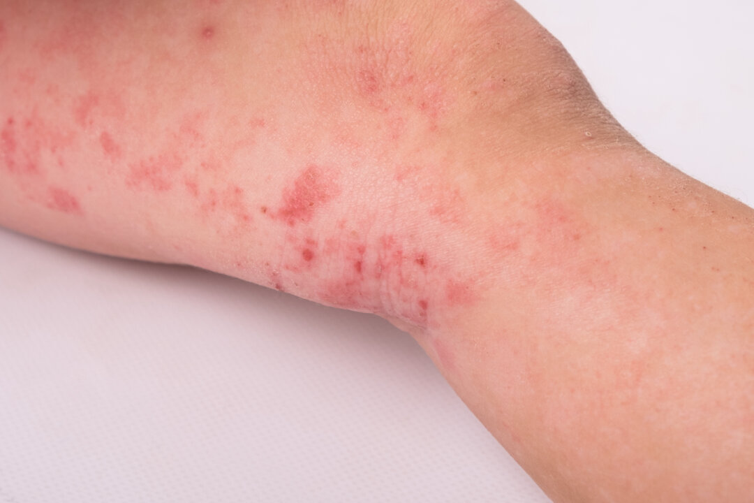 Link Between the Gut and Skin Is Key Factor in Eczema Report The Epoch Times