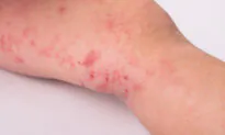 Link Between the Gut and Skin Is Key Factor in Eczema: Report