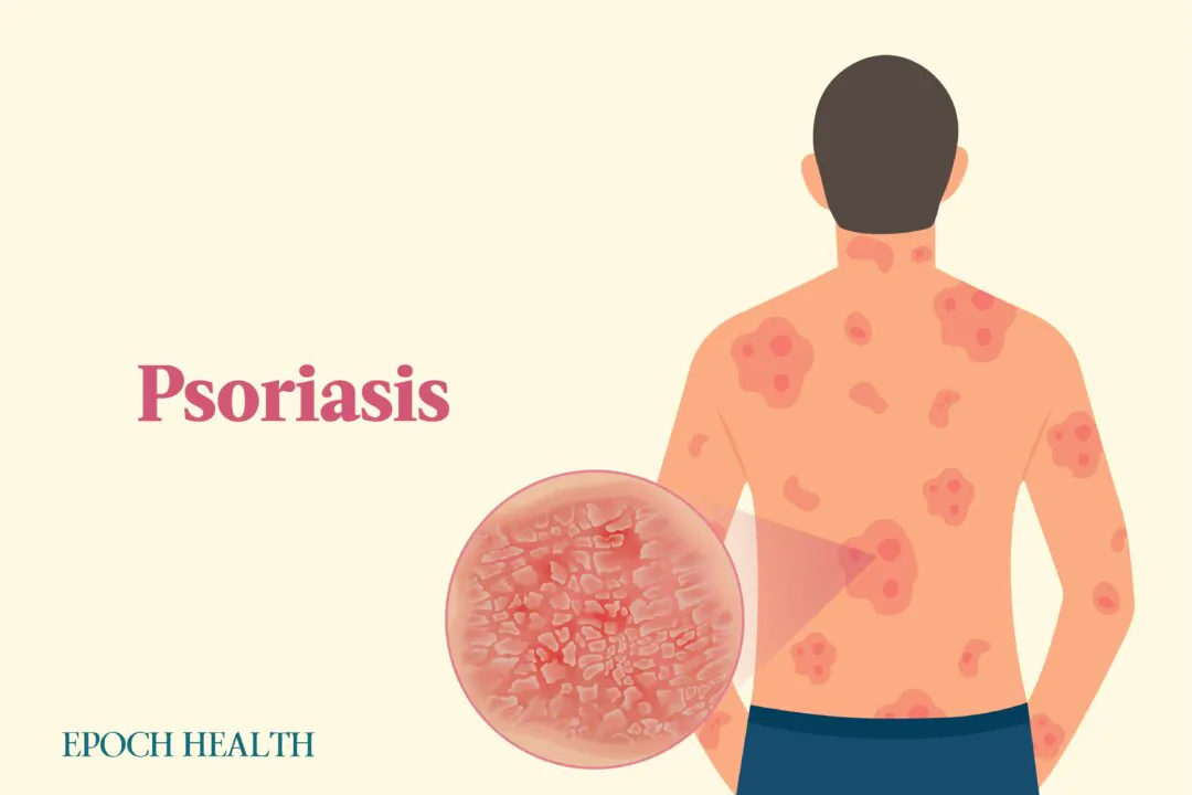 There are several types of psoriasis, though plaque psoriasis is most common. (Illustrations by The Epoch Times, Shutterstock)