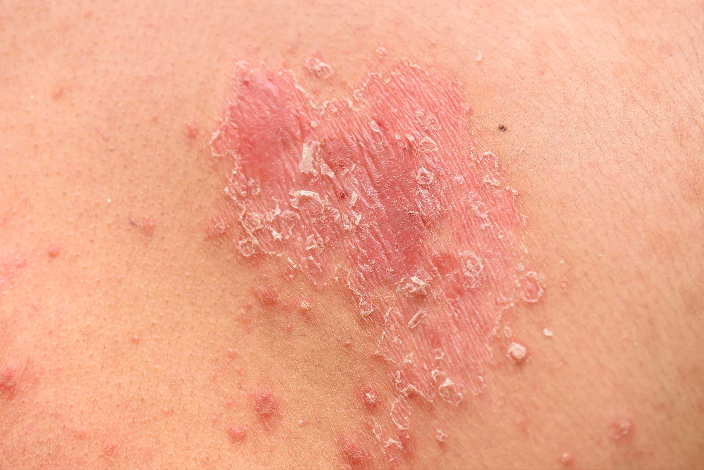 Symptoms and Causes of Psoriasis