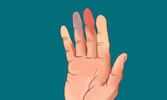 5 Exercises to Counter the Bizarre Symptoms of Raynaud’s Phenomenon