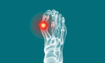 5 Therapist-Recommended Exercises to Reduce Painful Gout Flare-Ups