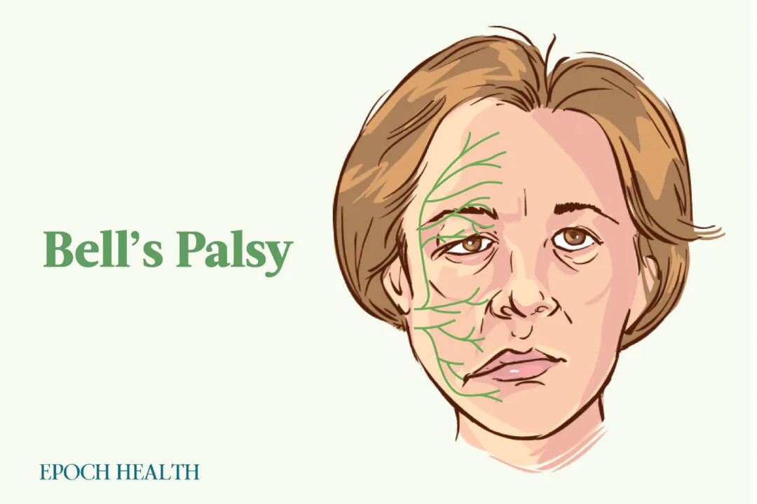 Bell's palsy occurs in about 15 to 30 people per 100,000. (Illustrations by The Epoch Times, Shutterstock)