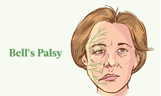 Bell’s Palsy: Symptoms, Causes, Treatments, and Natural Approaches
