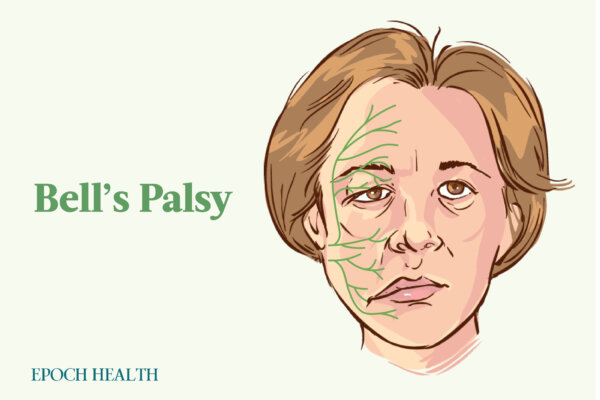 Unexpected Cause of Bell's Palsy