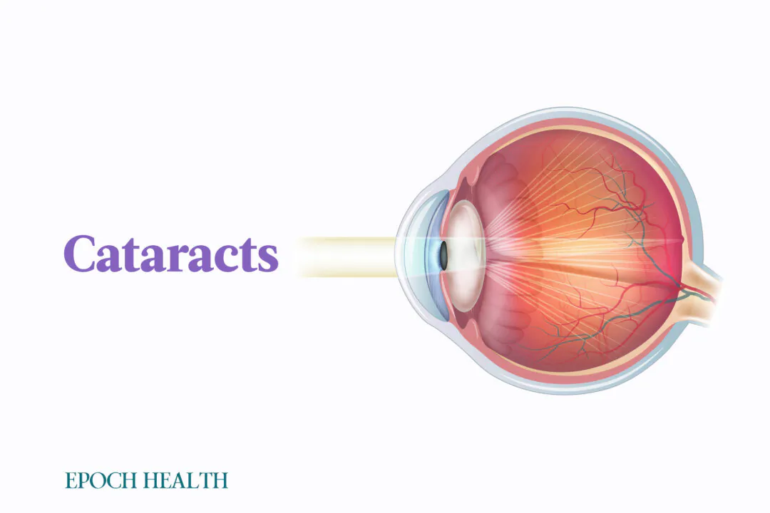 Cataracts are the most common cause of blindness. (Illustrations by The Epoch Times, Shutterstock)