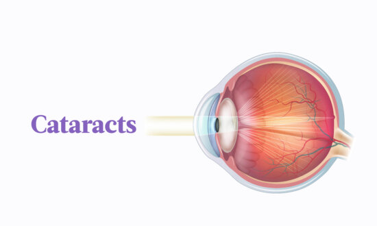 The Essential Guide to Cataracts: Symptoms, Causes, Treatments, and Natural Approaches