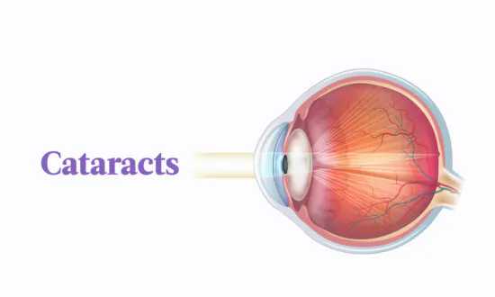 Cataracts: Symptoms, Causes, Treatments, and Natural Approaches