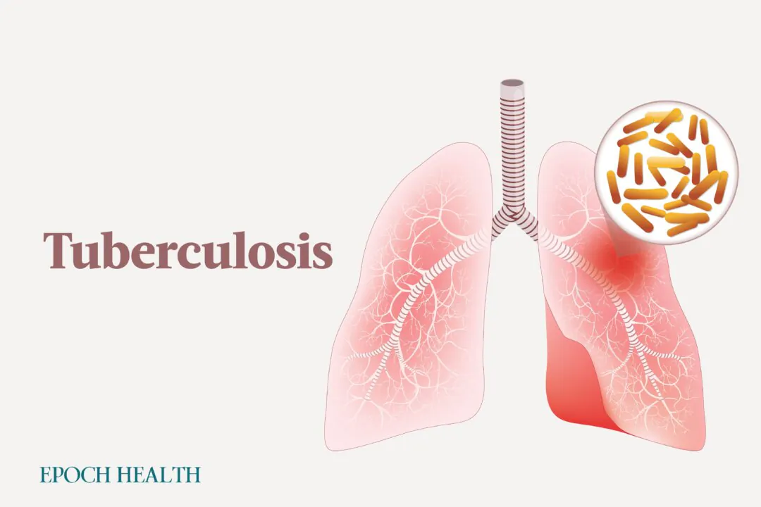 Tuberculosis is fortunately difficult to spread and is also preventable. (Illustrations by The Epoch Times, Shutterstock)