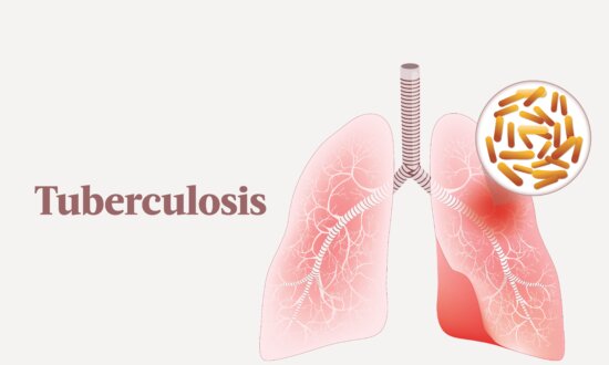 The Essential Guide to Tuberculosis: Symptoms, Causes, Treatments, and Natural Approaches